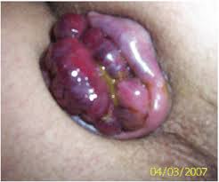 All became External bump near anus bleeds agree with External bump near anus bleeds