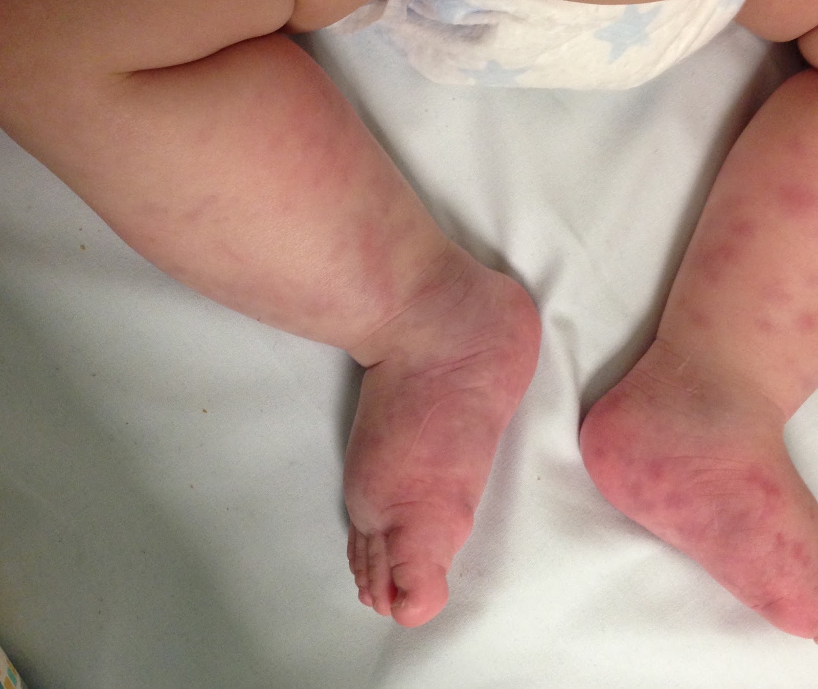 Typical rash distribution