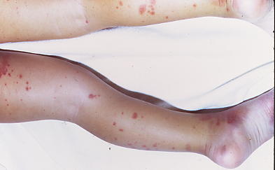henoch schonlein purpura india