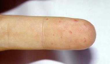 hereditary hemorrhagic telangiectasia hereditary hemorrhagic telangiectasia