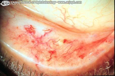 Hereditary hemorrhagic telangiectasia