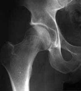 hip labral tear exercises pdf