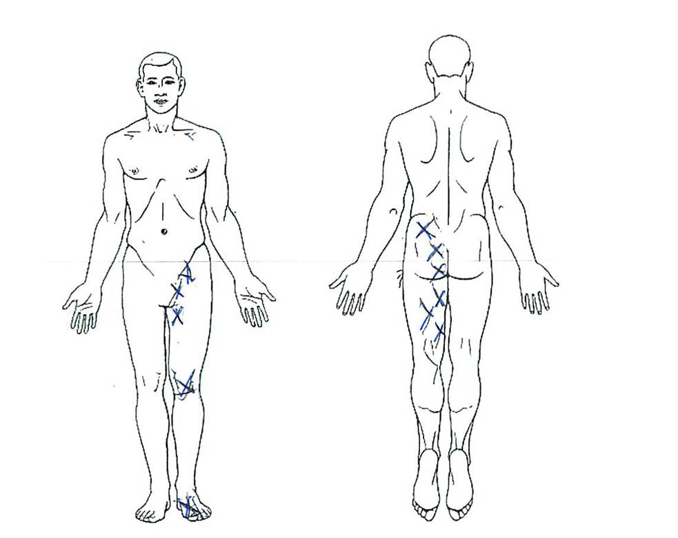 Hip Labral Tear Italy Pdf Ppt Case Reports Symptoms Treatment