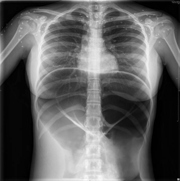 Hirschsprungs disease