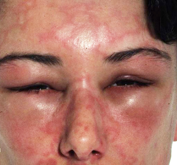 Hives and angioedema