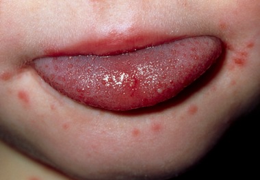 Hives and angioedema