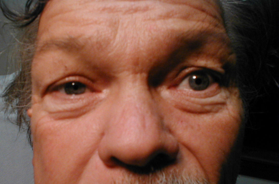 Horner syndrome Finland PDF PPT Case Reports Symptoms Treatment