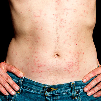 mild mild case mild swimmers itch mild mild case mild swimmers itch