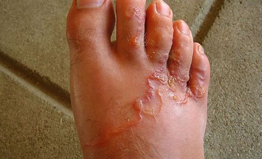 hookworms in humans diagnosis hookworms in humans diagnosis