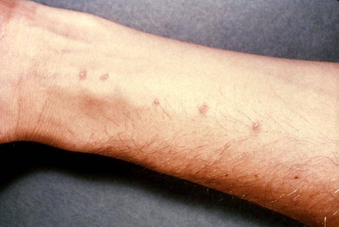 hookworms in humans pregnant hookworms in humans pregnant