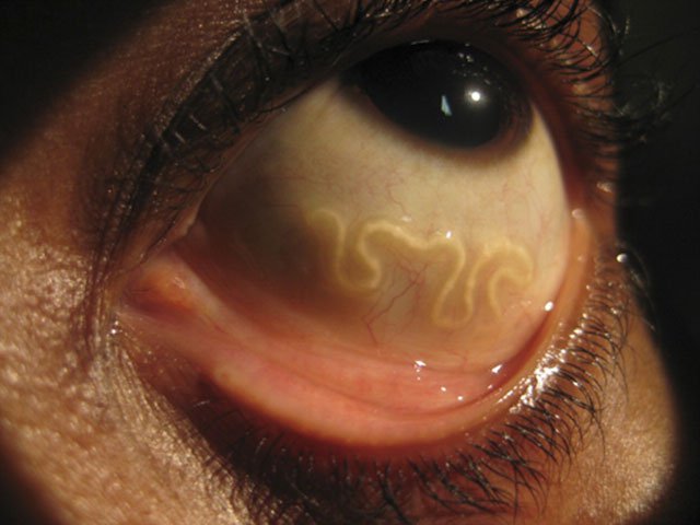 hookworms in humans pregnant hookworms in humans pregnant