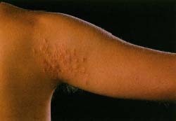 Diseases Both Dogs And People Can Get Diseases Both Dogs And People Can Get