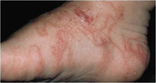 hookworms in humans rash