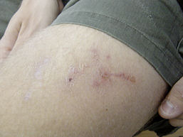 hookworms in humans pregnant hookworms in humans pregnant