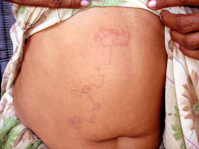 number of hookworms in humans number of hookworms in humans