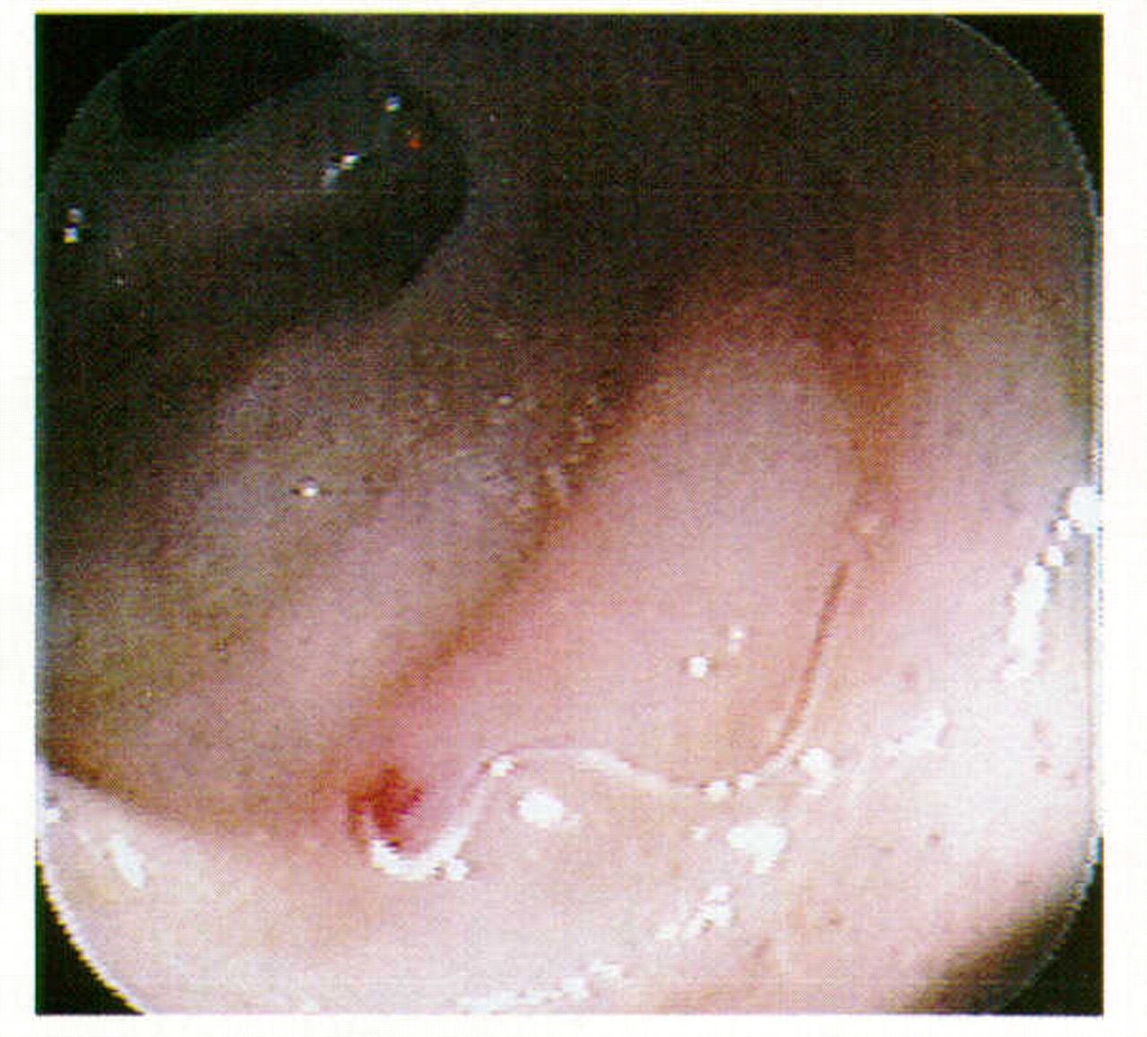 Human Hookworm | Switzerland| PDF | PPT| Case Reports | Symptoms | Treatment1280 x 1157
