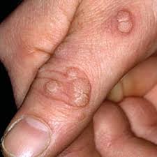 human papillomavirus infection in neonates wart foot cream