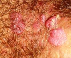 Hpv virus on males, How to get rid of hpv virus in males. - Papillomavirus infection in males
