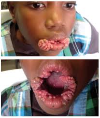 Human papillomavirus infection on tongue