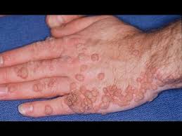 papillomavirus human infection hpv disease treatment warts