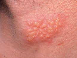Is hpv a virus or bacterial infection Which virus or bacteria causes hpv