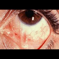human papilloma virus ocular