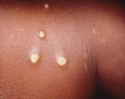 Human papillomavirus infection go away, Human papillomavirus infection goes away