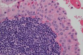 Hurthle cell Cancer | Mexico| PDF | PPT| Case Reports | Symptoms ...