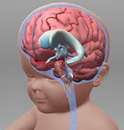 Hydrocephalus