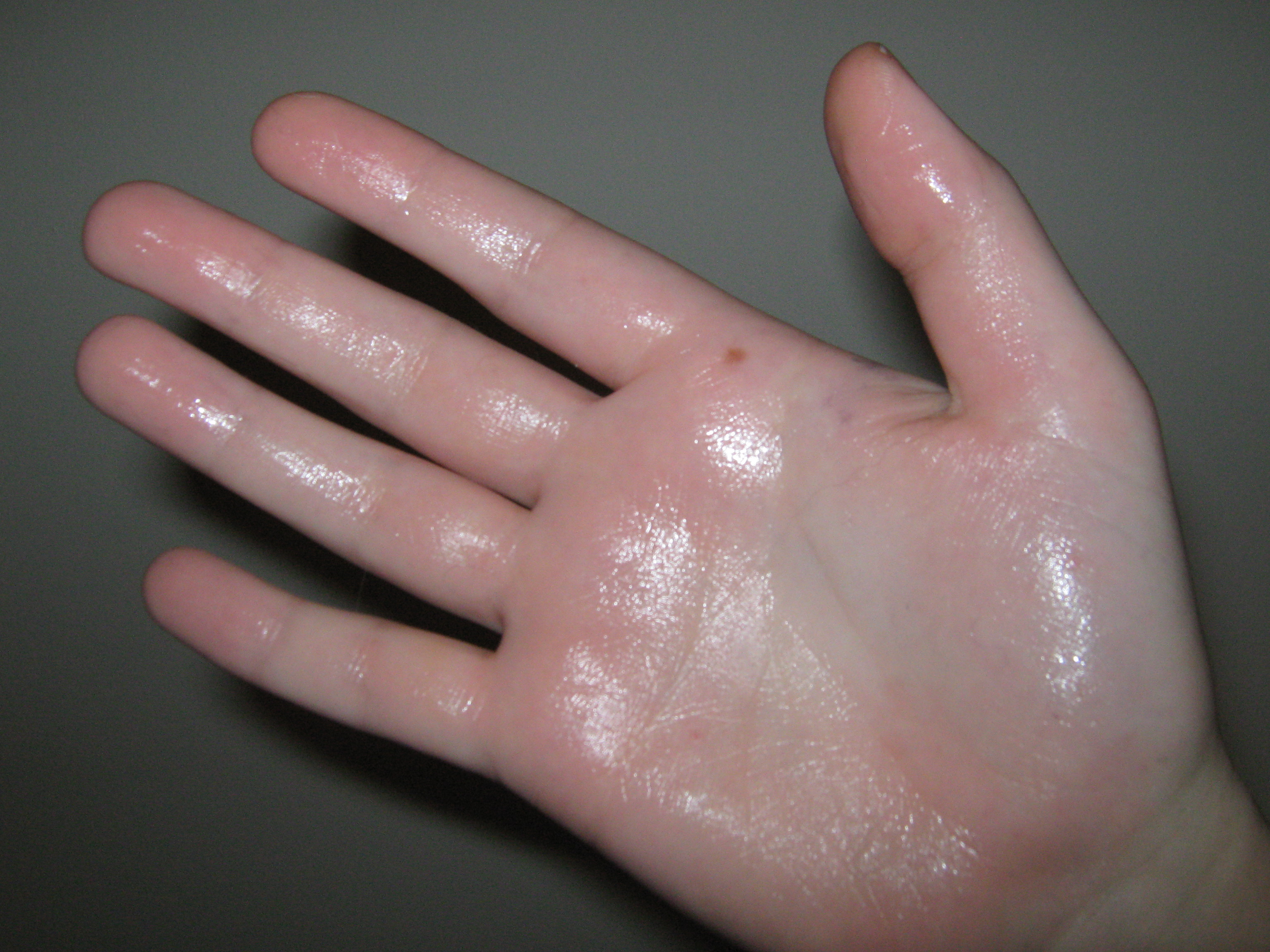 Hyperhidrosis