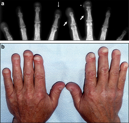 hyperparathyroidism parathyroid kidney international tertiary manifestations symptoms disease figure patient resorption articles ppt pdf digital