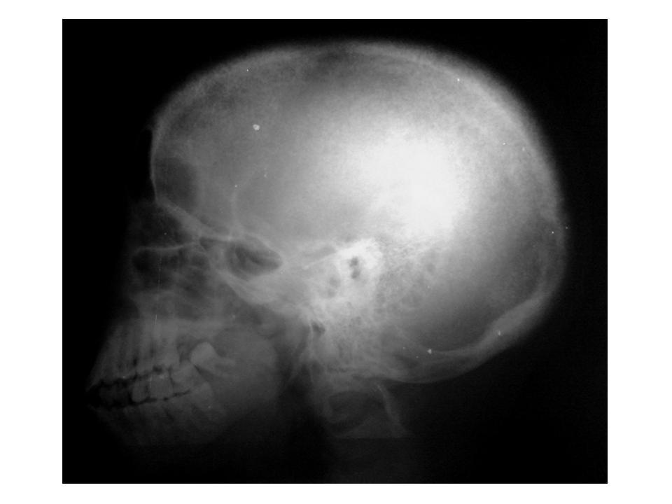 Primary Hyperparathyroidism Radiology
