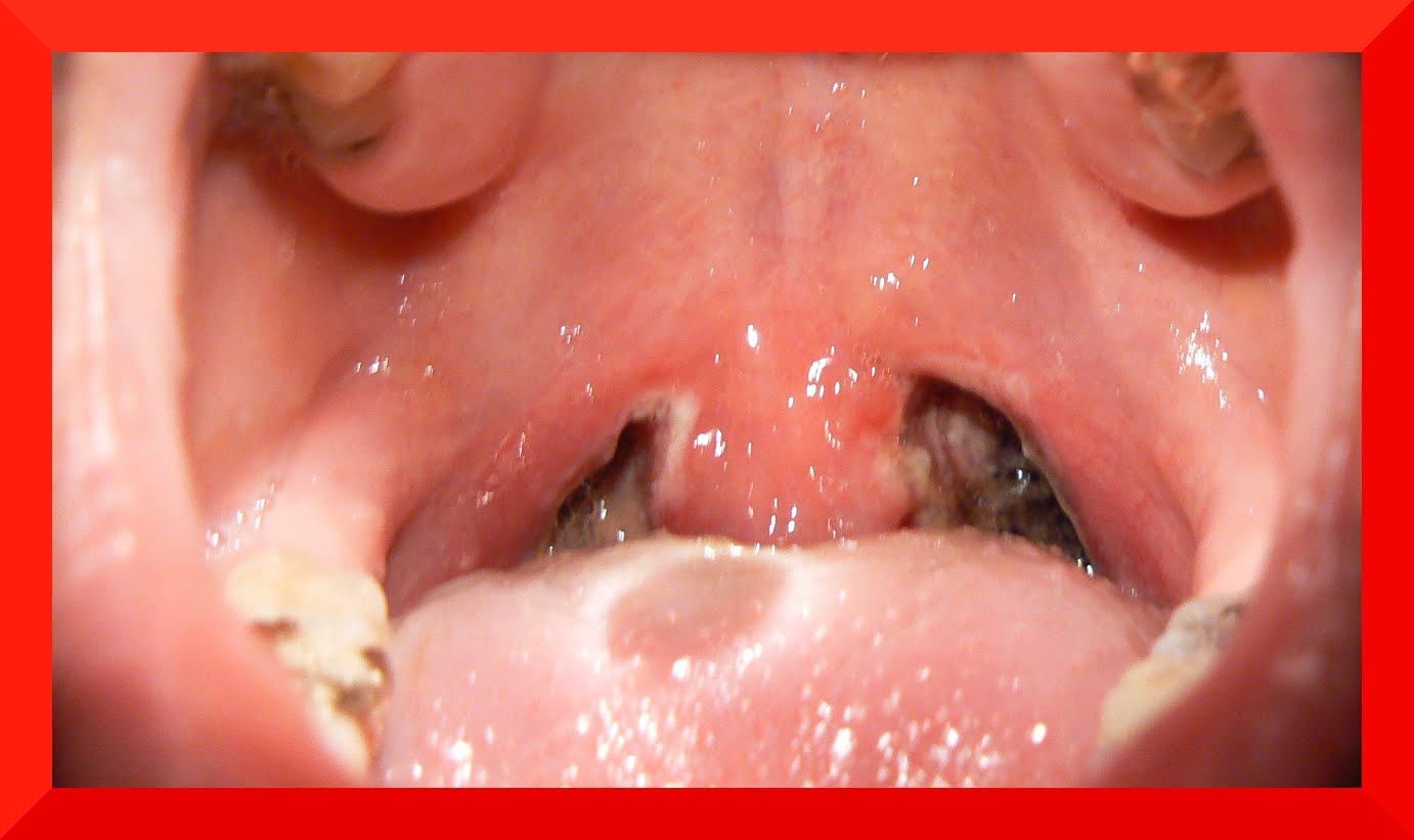 Hypothyroidism | United States| PDF | PPT| Case Reports ...