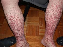 What is idiopathic thrombocytopenic purpura?