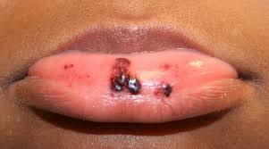 immune thrombocytopenic purpura