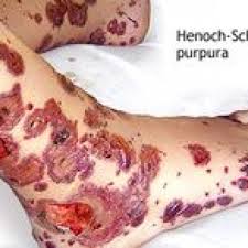 immune thrombocytopenic purpura