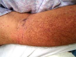 immune thrombocytopenic purpura