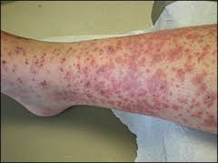 thrombotic thrombocytopenic purpura