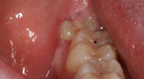 Fascination About Wisdom Teeth After Removal