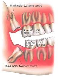 Impacted wisdom teeth | United States| PDF | PPT| Case ...