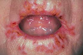Certainly not Impetigo in adult commit error Congratulate, Impetigo in adult can
