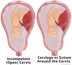 Incompetent Cervix Russian Federation Pdf Ppt Case Reports Symptoms Treatment