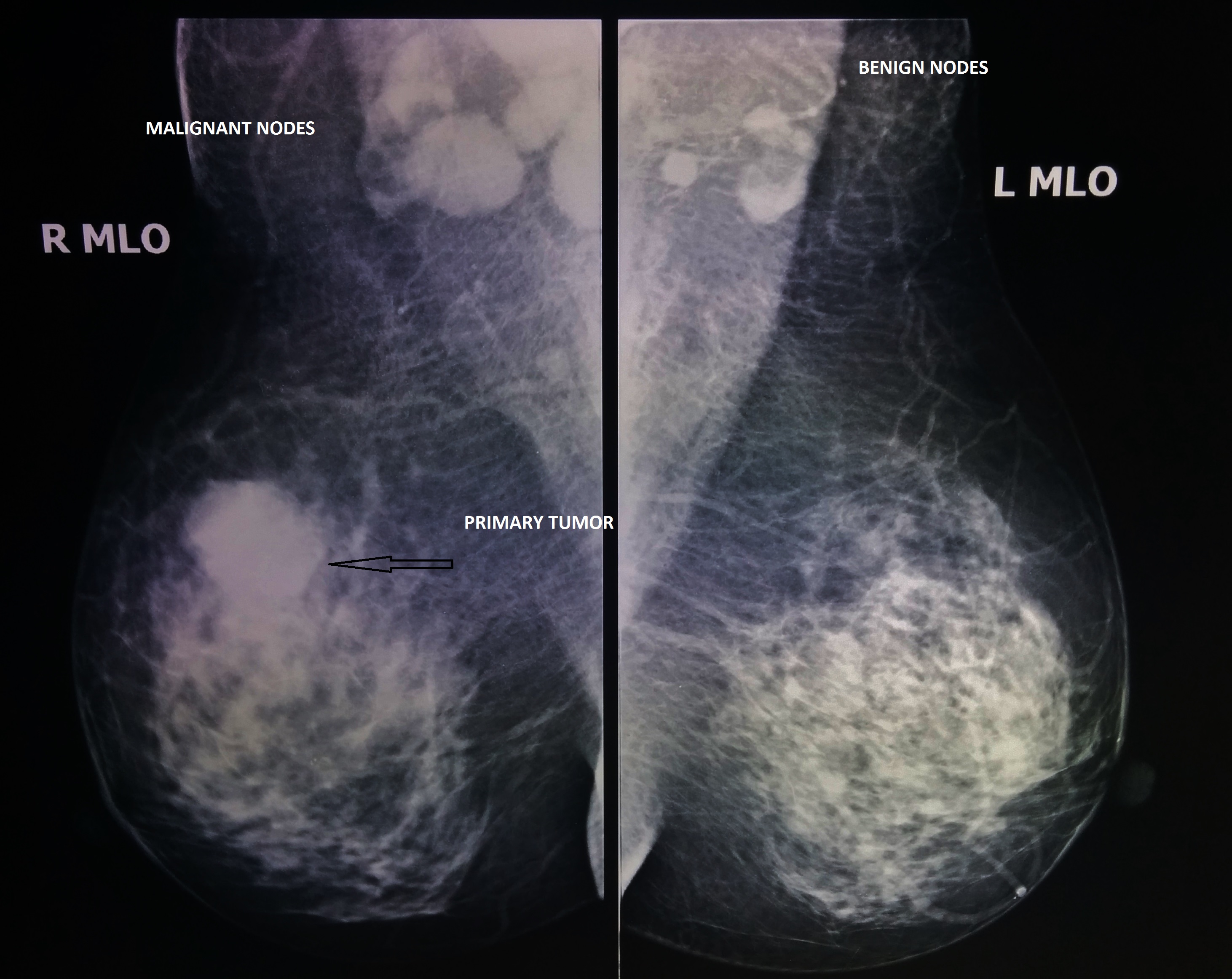 Inflammatory Breast Cancer Brazil Pdf Ppt Case Reports Symptoms
