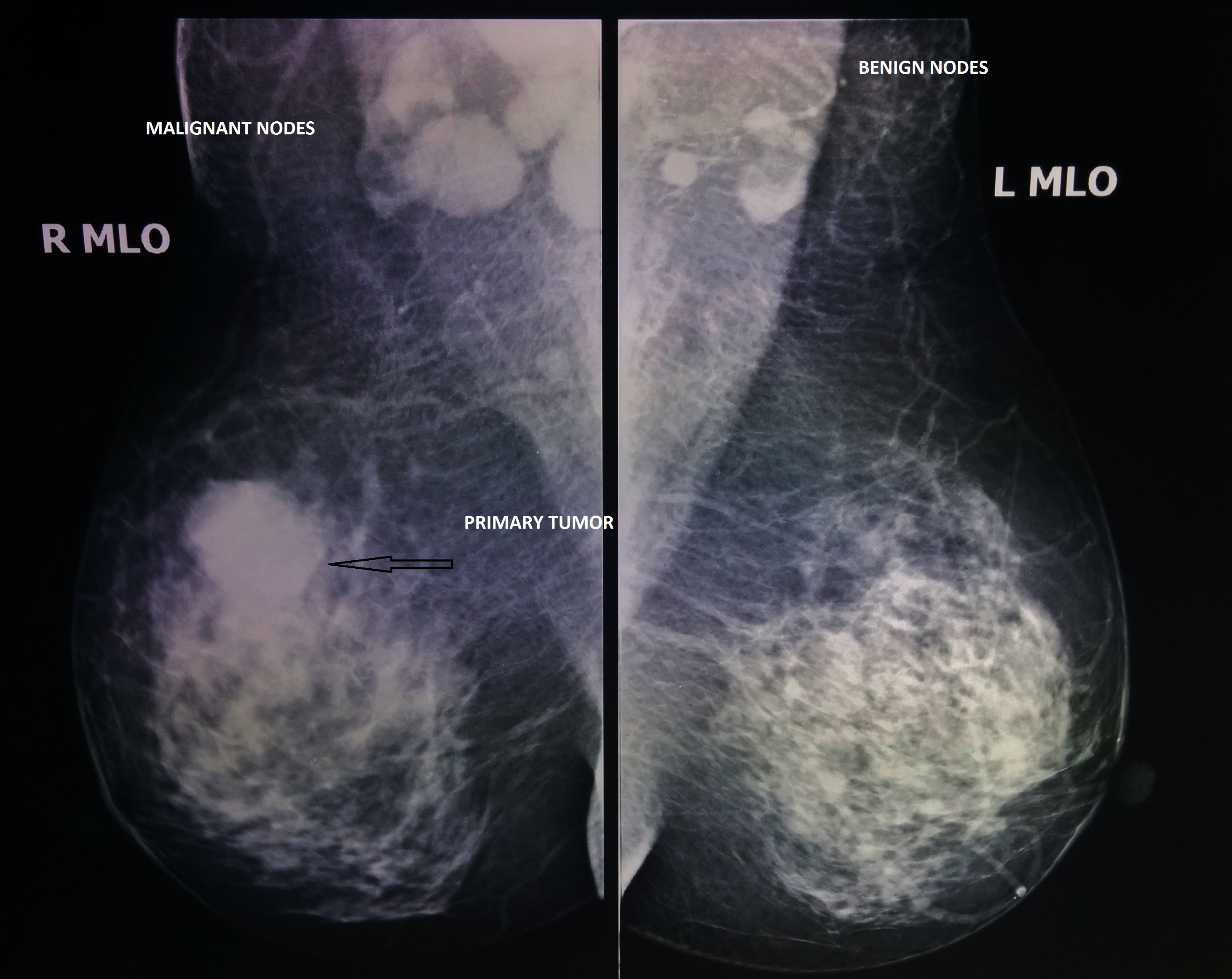 Inflammatory Breast Cancer Japan Pdf Ppt Case Reports Symptoms Treatment