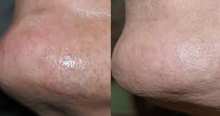 ingrown hair mexico pdf ppt case reports symptoms treatment