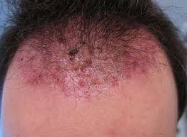 ingrown hair italy pdf ppt case reports symptoms treatment
