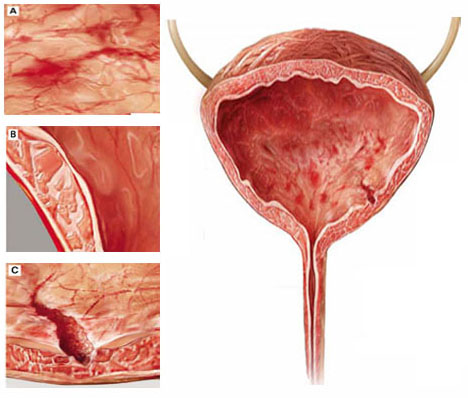 Cystitis meaning