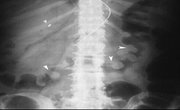 what is ischemic colitis what is ischemic colitis