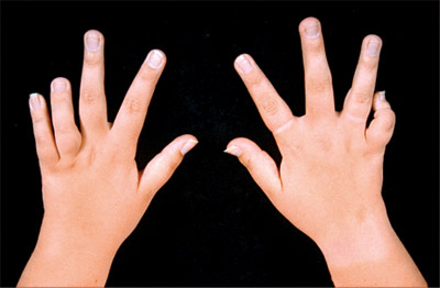 Juvenile Rheumatoid Arthritis, Diagnosis of Juvenile Rheumatoid Arthritis, Treatment of Juvenile Rheumatoid Arthritis, and 4 Nursing Care Plan Examples for Juvenile Rheumatoid Arthritis