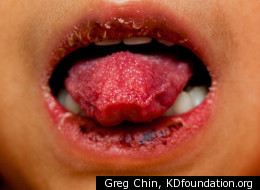 kawasaki disease ppt Kawasaki disease: an update of diagnosis and treatment. Ppt download.